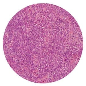 Biphasic mesothelioma cells